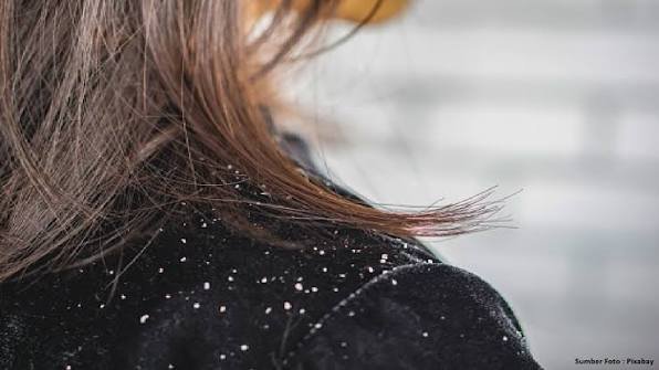 Mengatasi Ketombe, Cara Merawat Kulit Kepala agar Rambut Kembali Nyaman